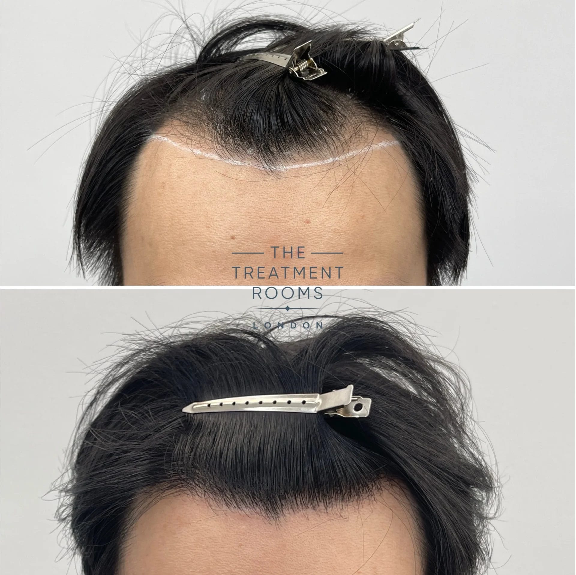 high density hairline transplant