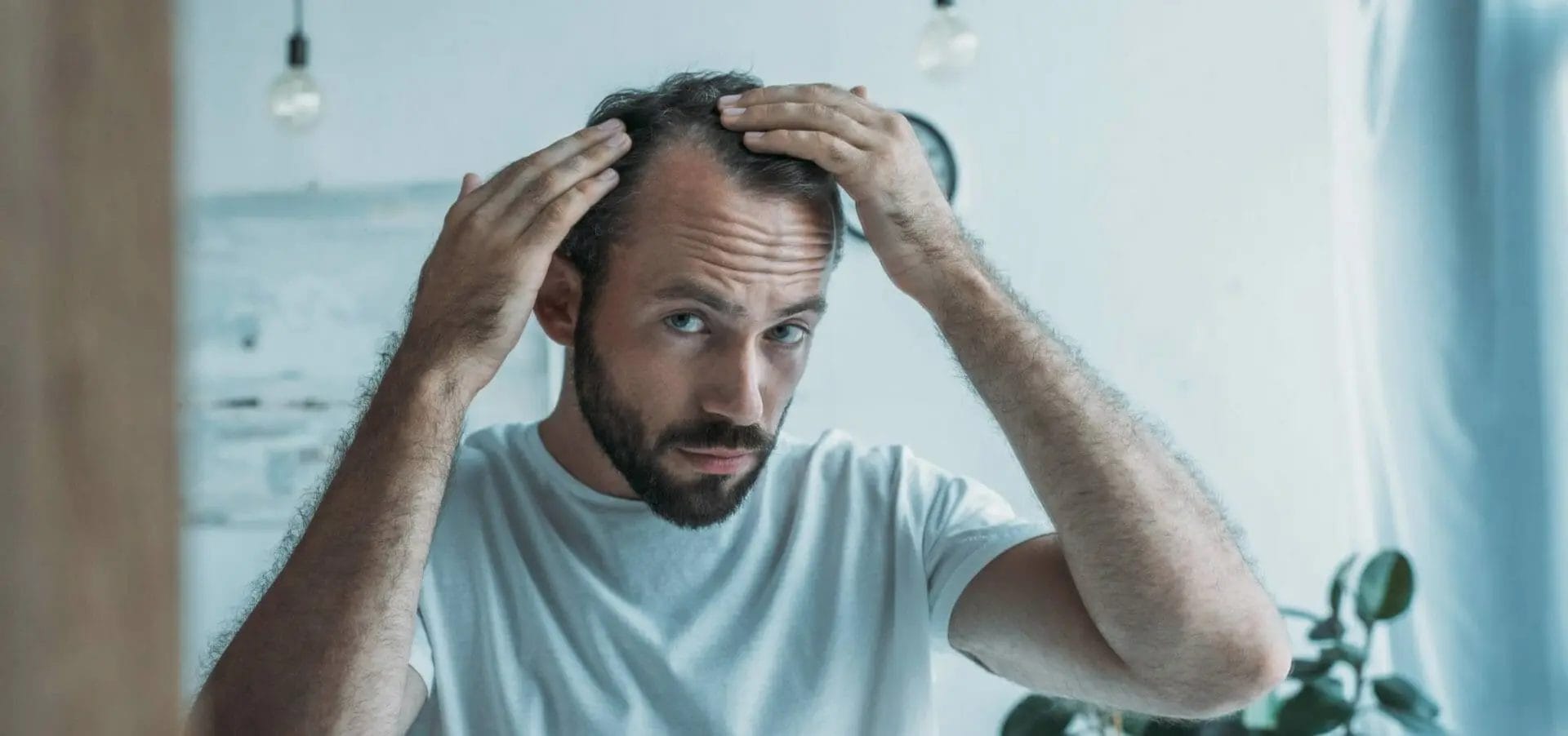 temple hair loss and hair transplant