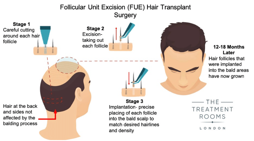 FUE Hair Transplant Surgery Diagram
