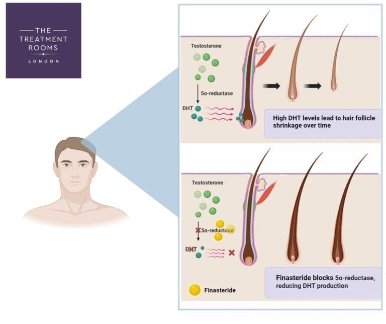 image explaining how finasteride lowers DHT production thereby reducing hair loss