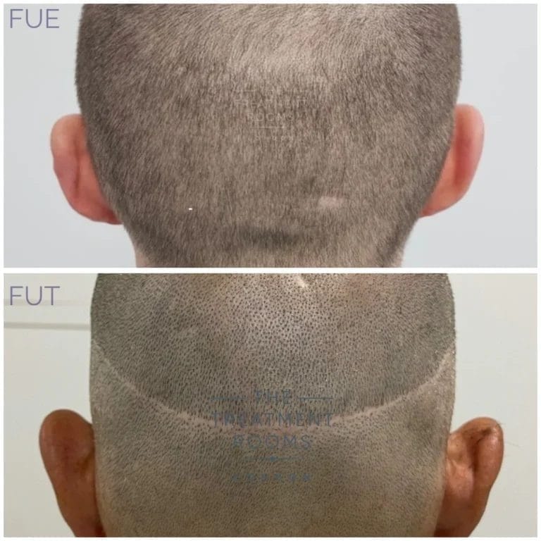 an image comparing and FUE and FUT hair transplant