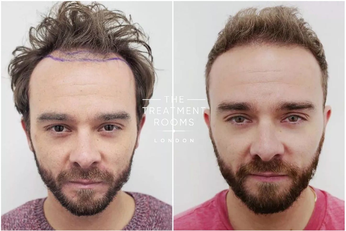 jack hair transplant before and after