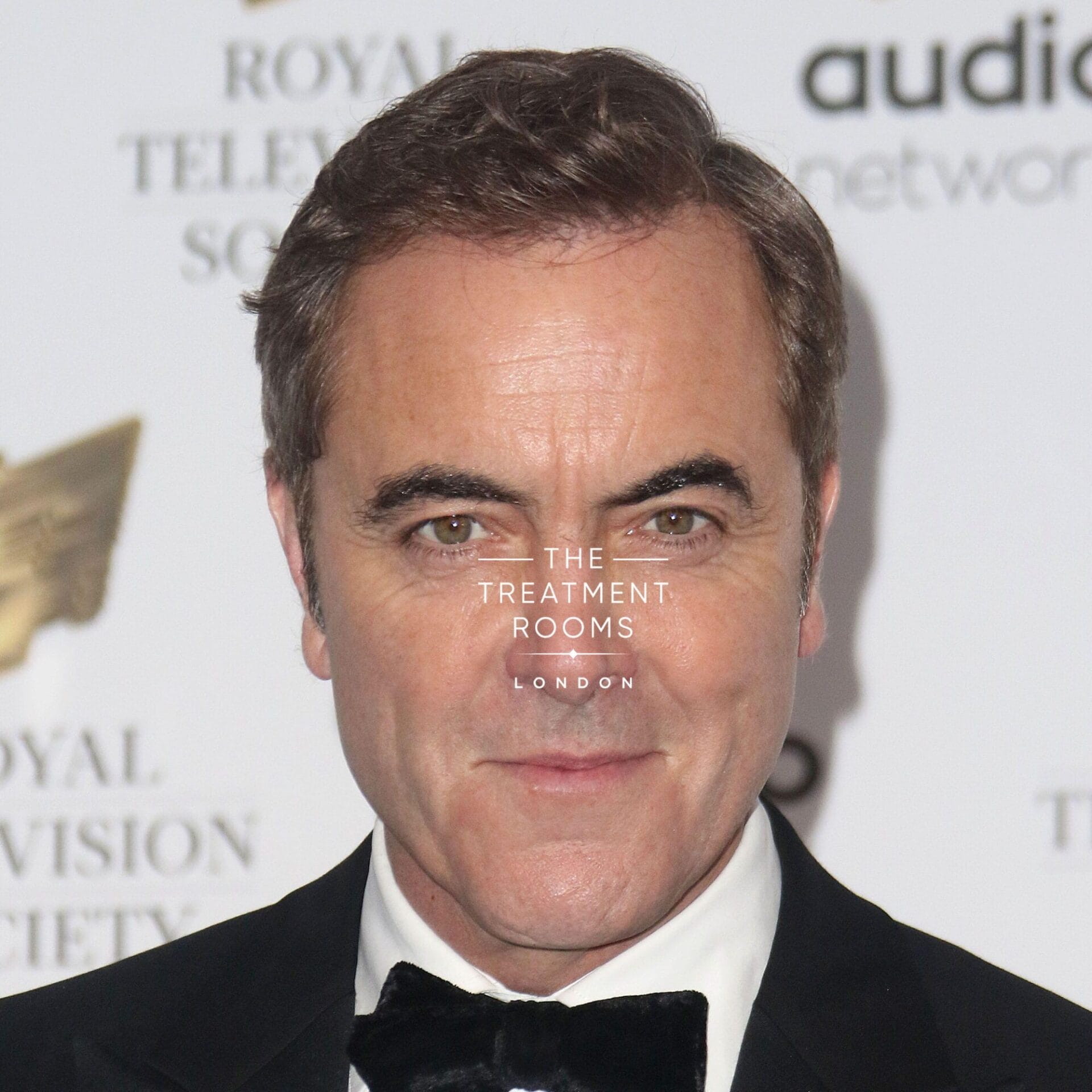 James Nesbitt with a fuller hairline after undergoing hair transplant