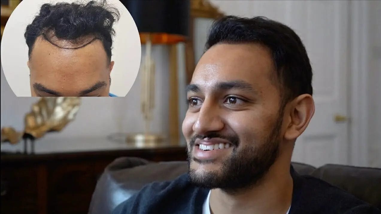 kiran fue hair transplant result video
