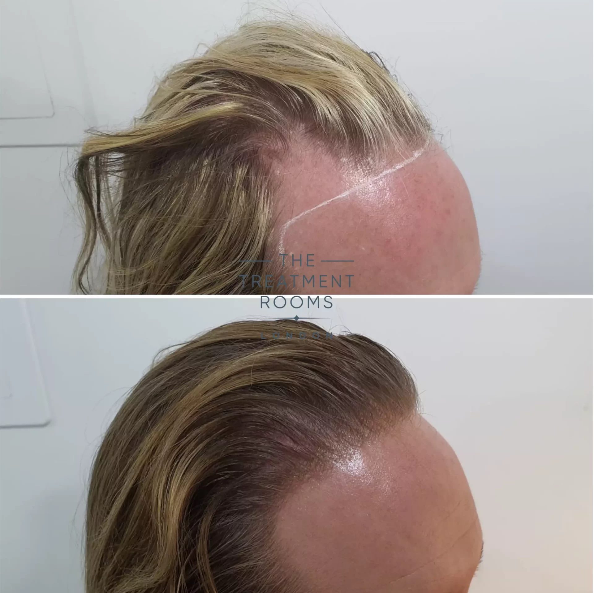 large-transgender-hair-transplant-cost-hairline-feminisation large transgender hair transplant cost hairline feminisation