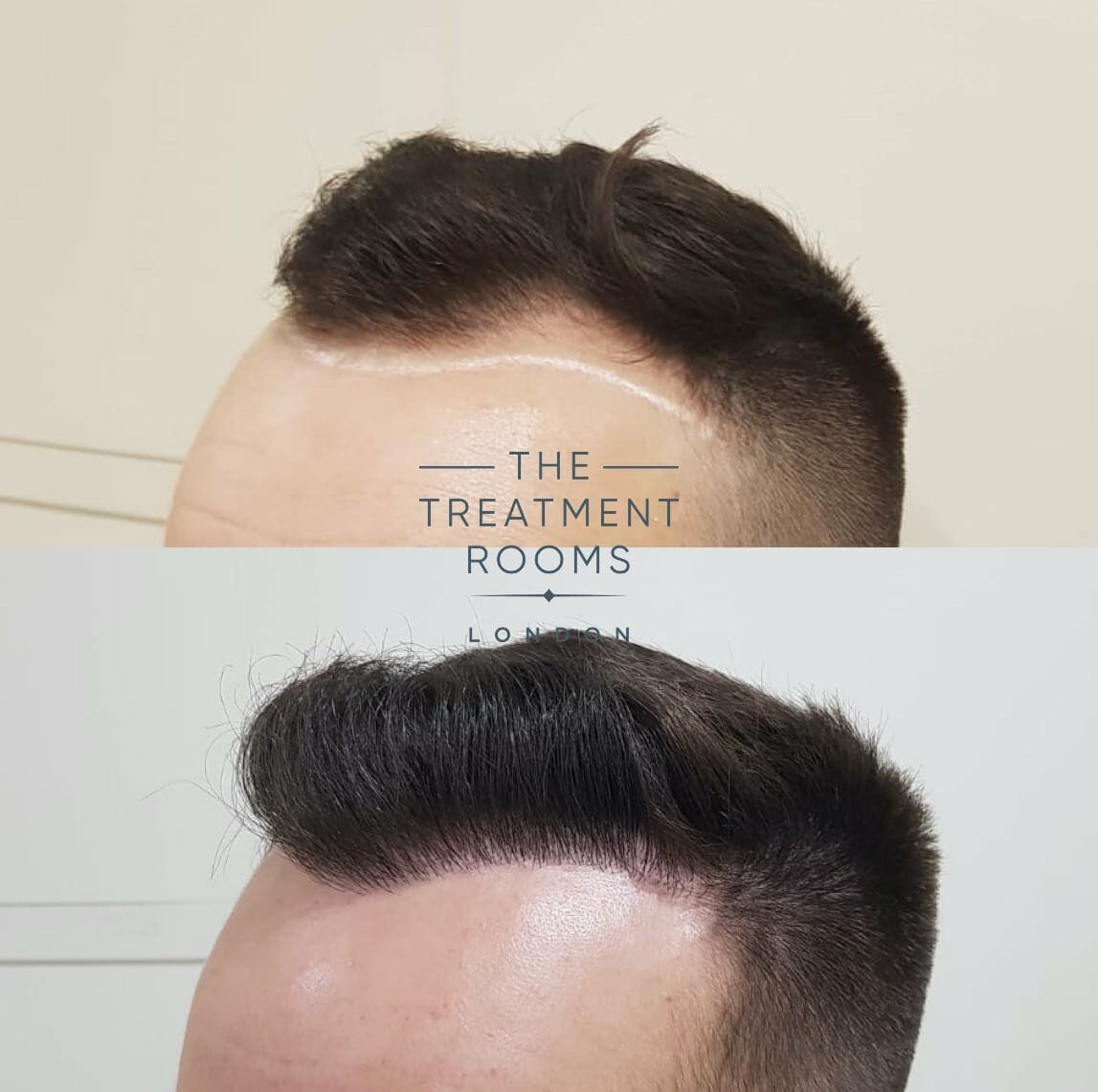 left frontal hairline hair transplant