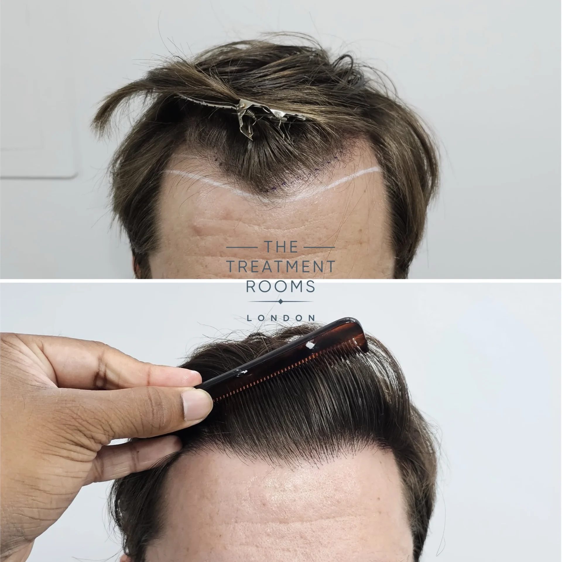 london fue hair transplant 1384 grafts before and after surgery