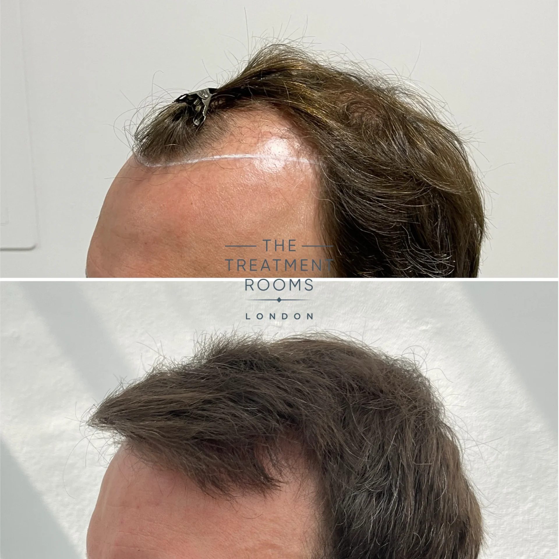 london fue hair transplant 3667 grafts before and after