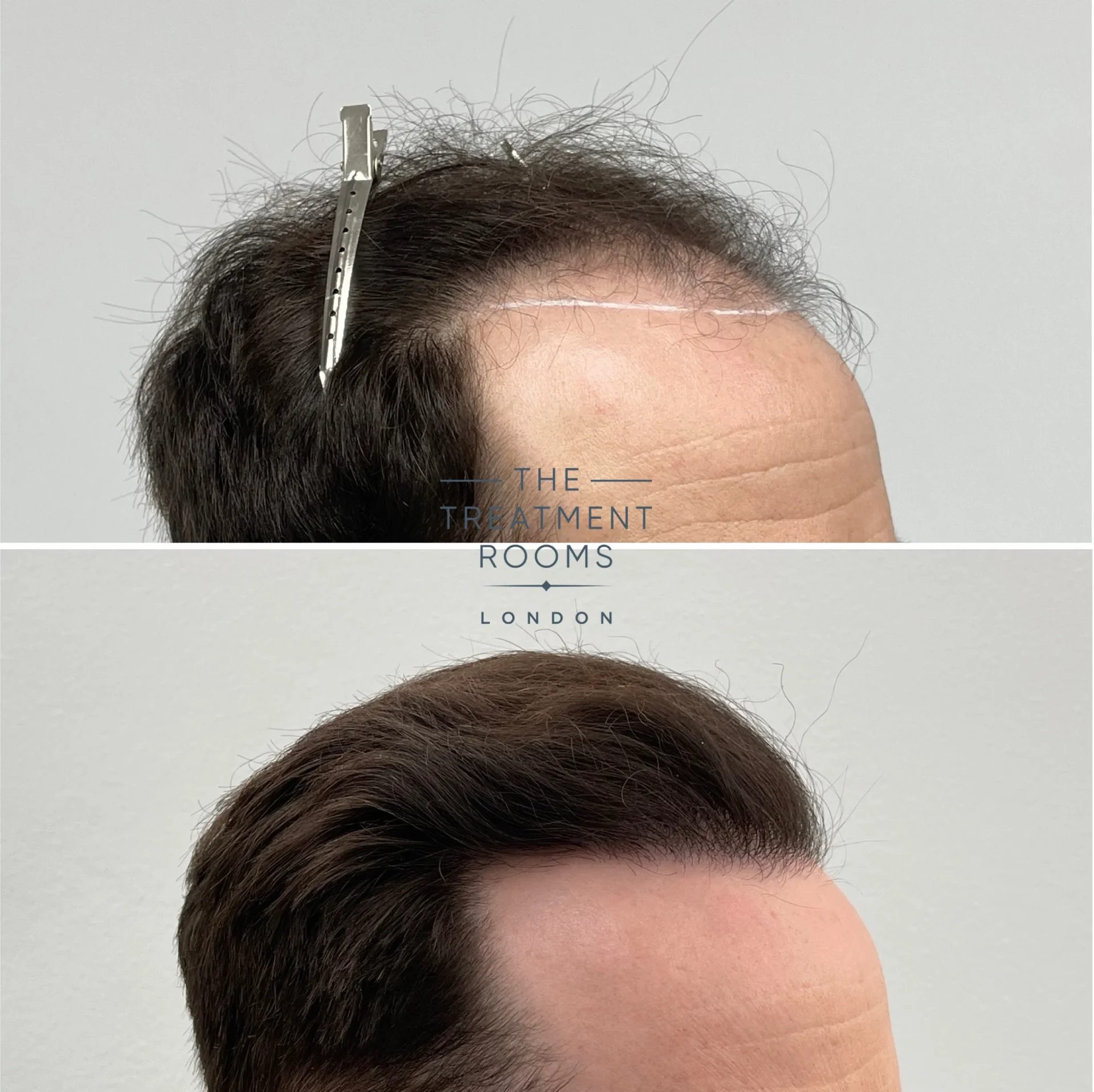 london fue hair transplant clinic 1960 grafts before and after