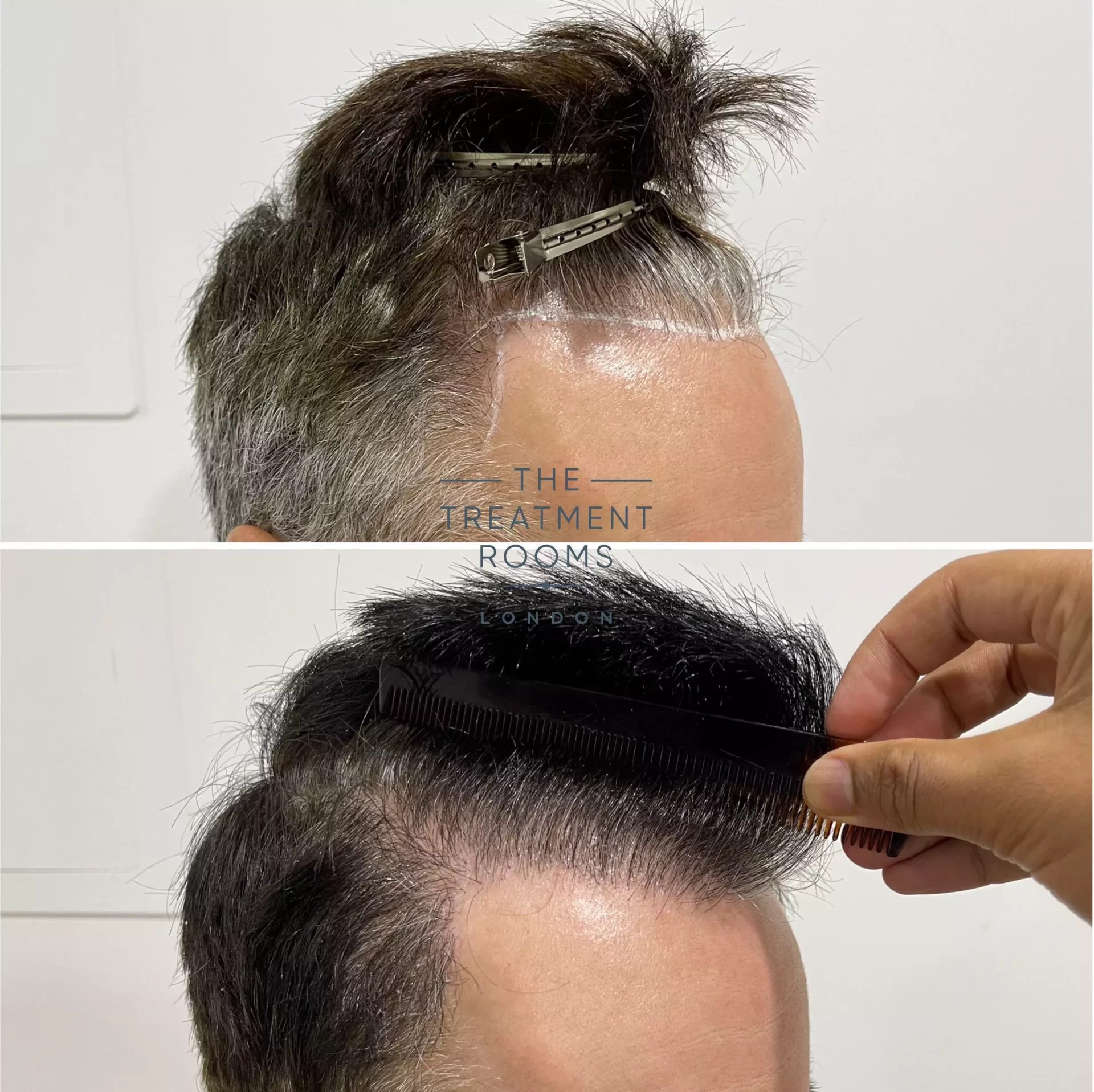 london hair transplant clinic repair 1264 grafts london hair transplant clinic repair 1264 grafts