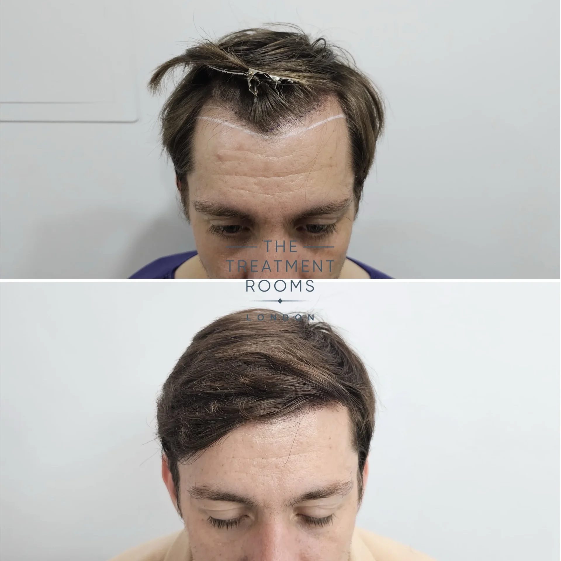 london hair transplant 1384 grafts before and after