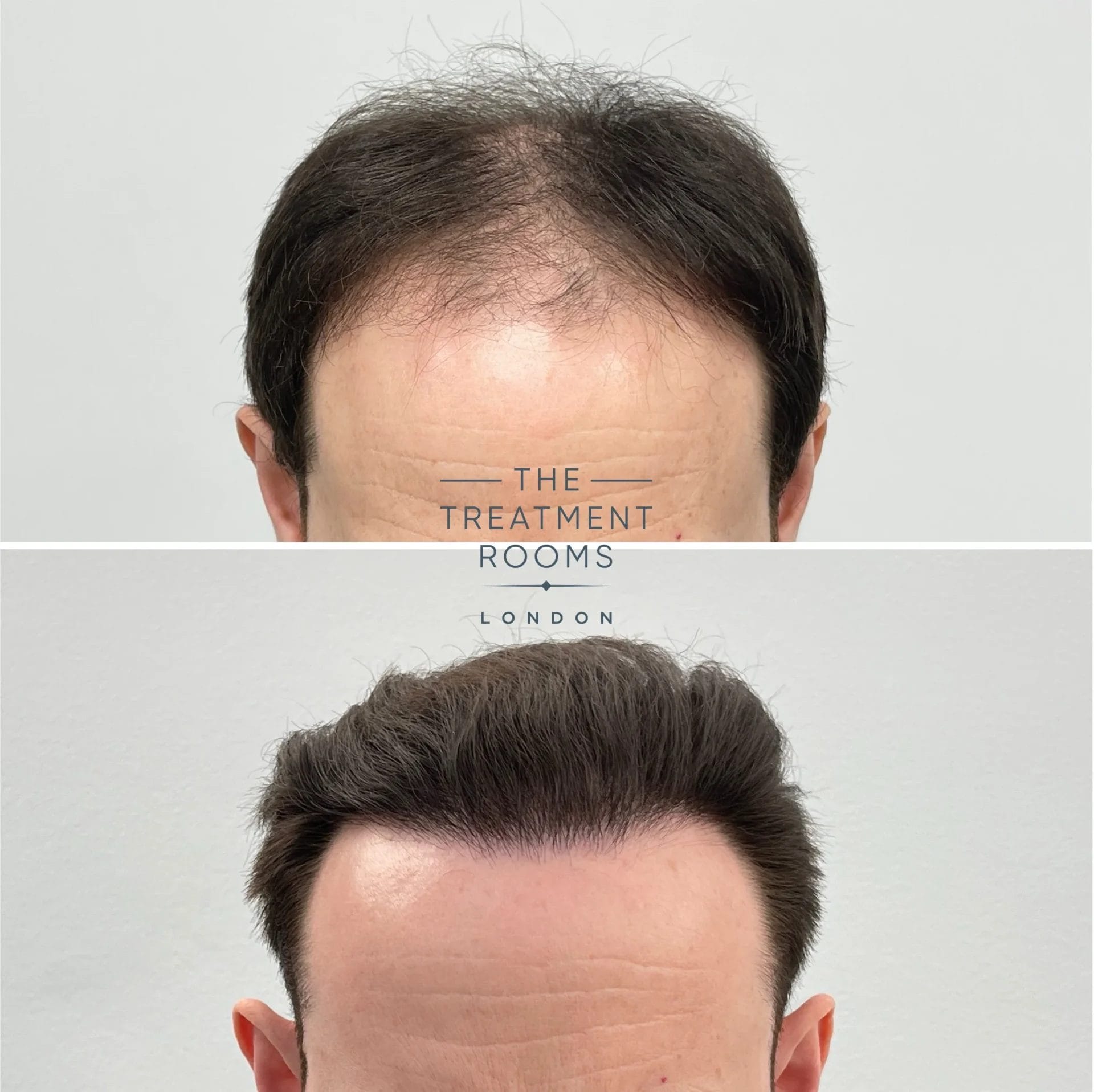 london hair transplant 1960 grafts before and after