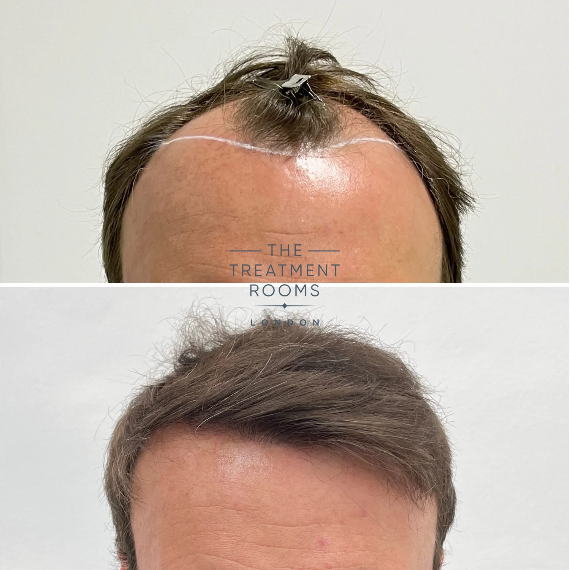 london hair transplant 3667 grafts before and after