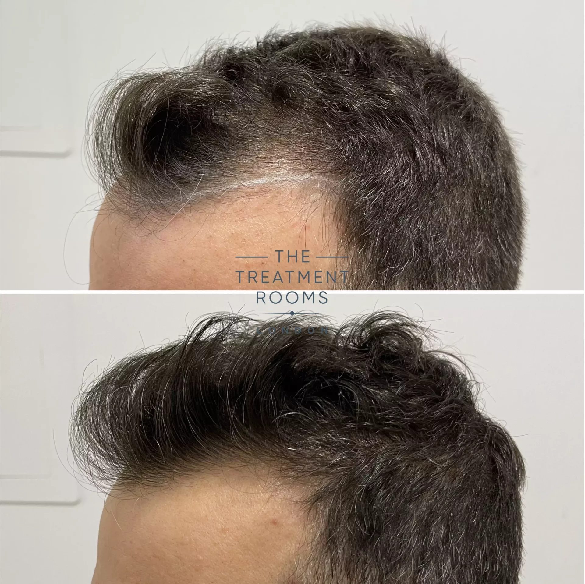 london hair transplant clinic 1321 grafts before and after london hair transplant clinic 1321 grafts before and after