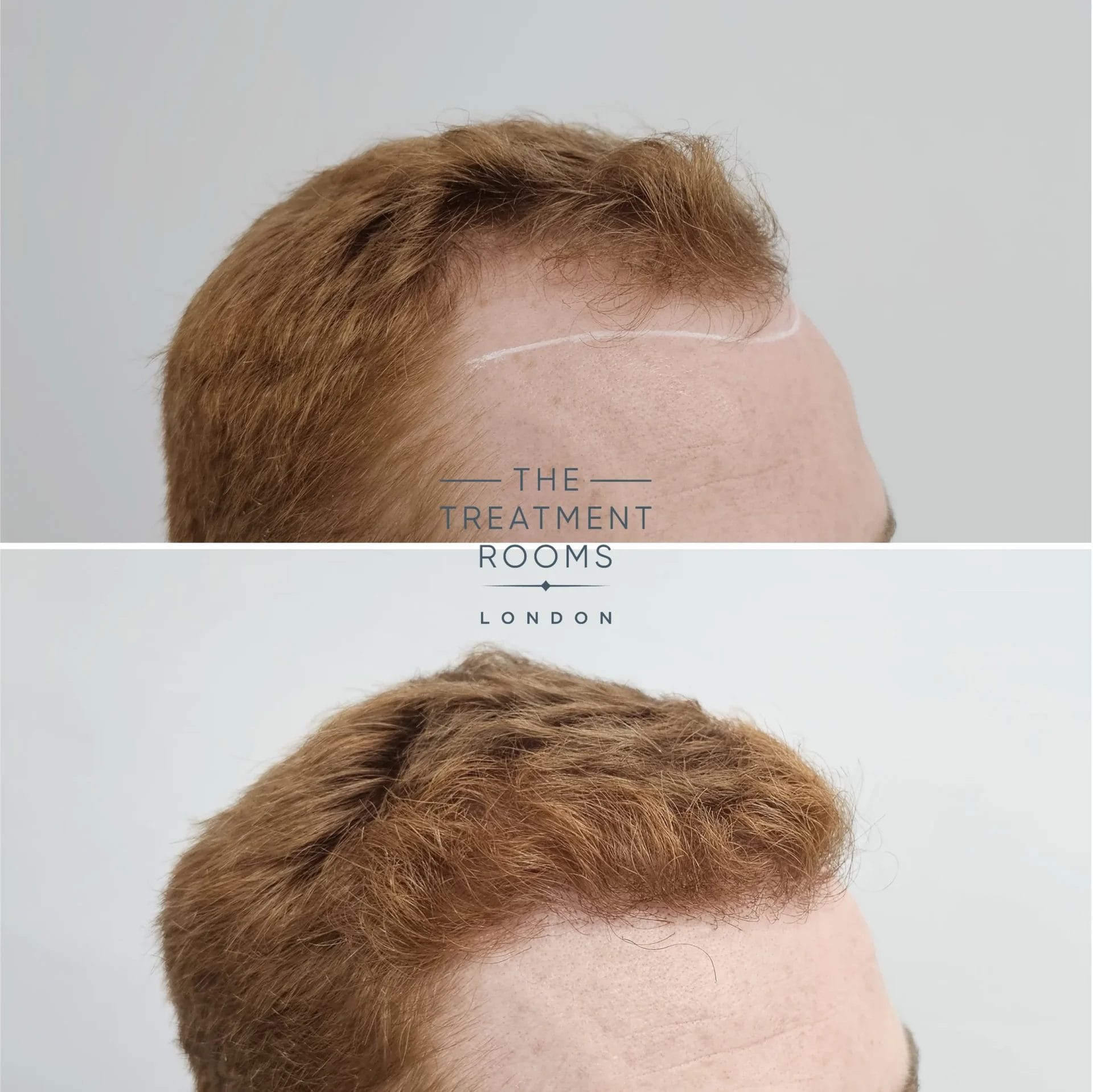 london hair transplant clinic before and after 1898 grafts