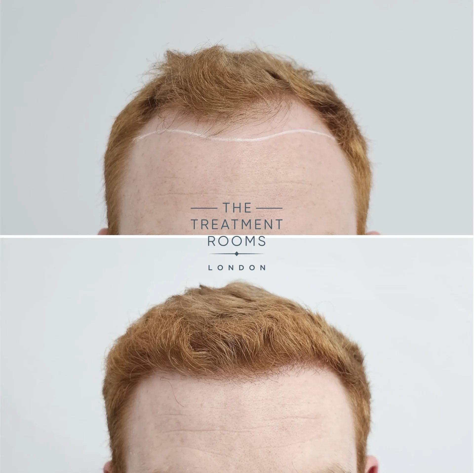 london hair transplant clinic hairline before and after 1898 grafts