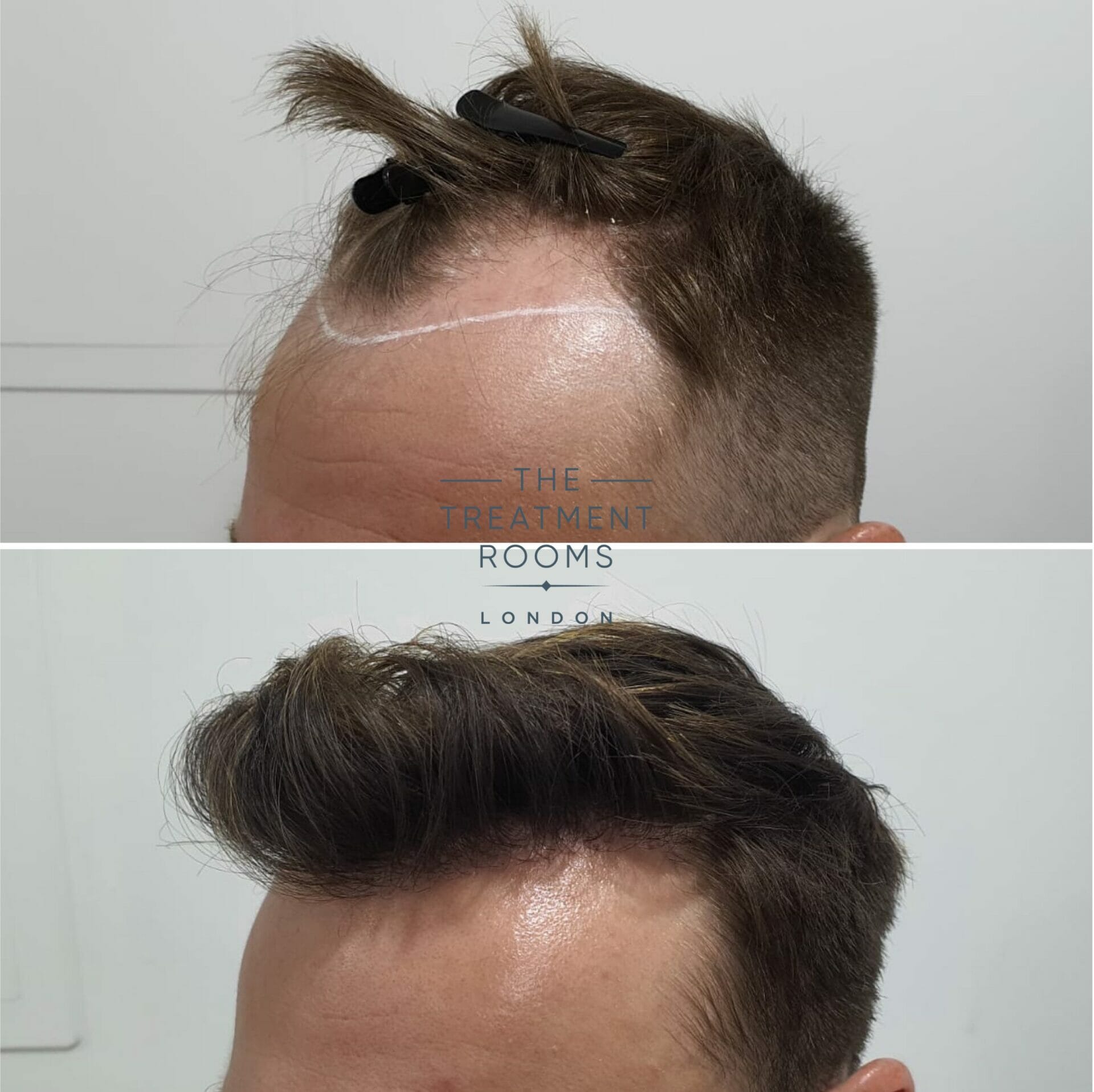 long lasting hair transplant with finasteride