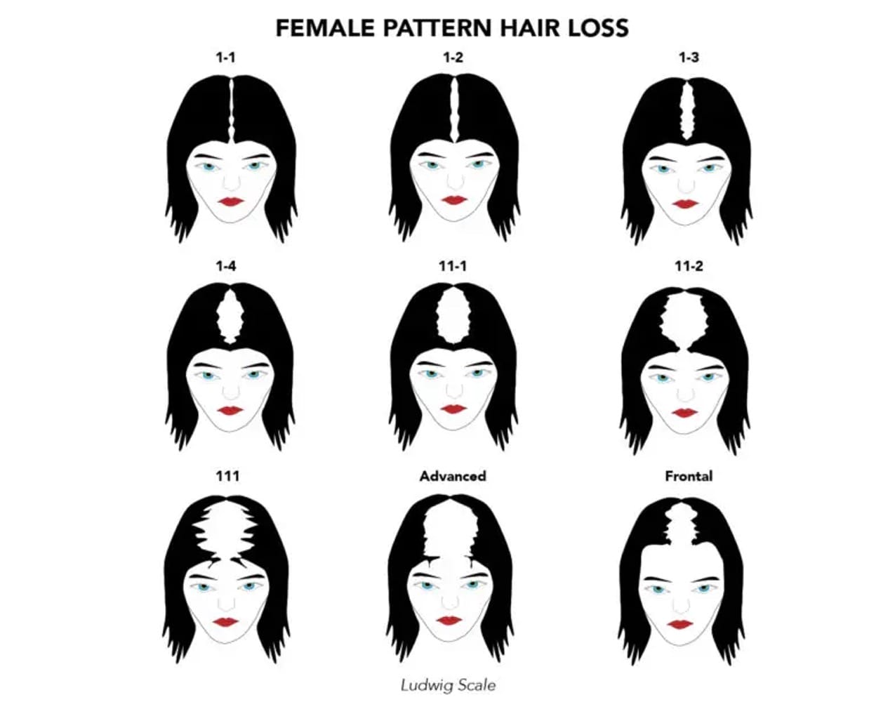 ludwig scale for female hair loss stages