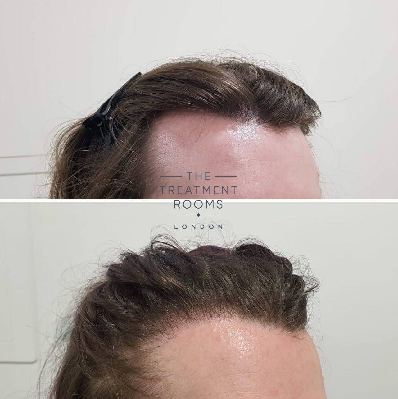 male to female transgender hair transplant