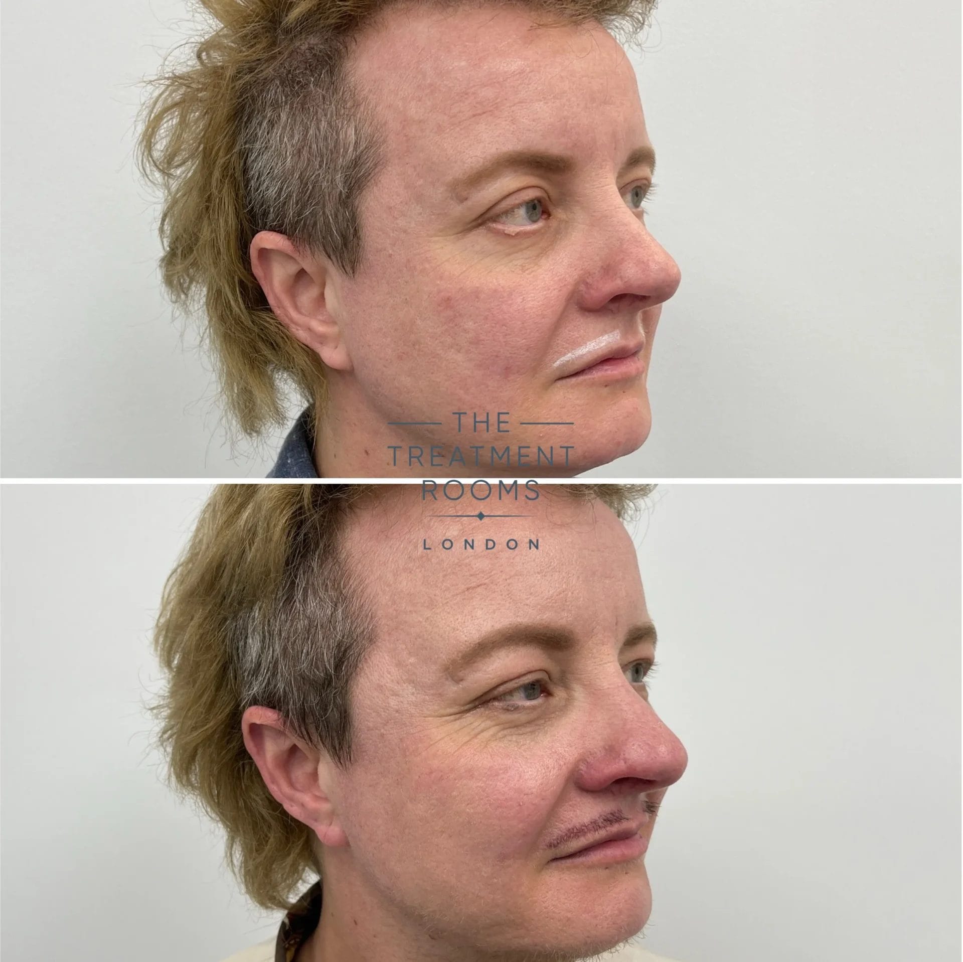 transgender moustache hair transplant london