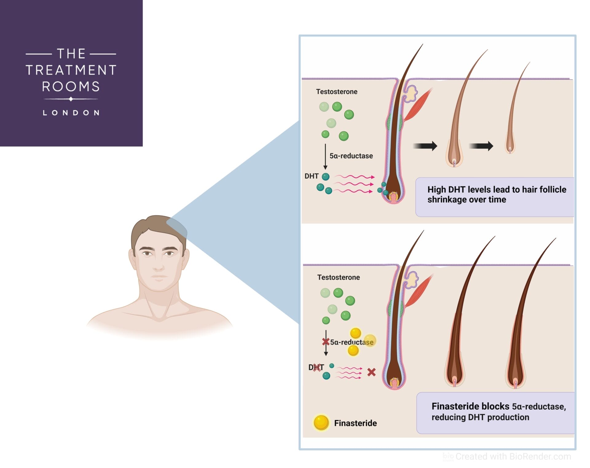 DHT-Blockers Mechanism of Action