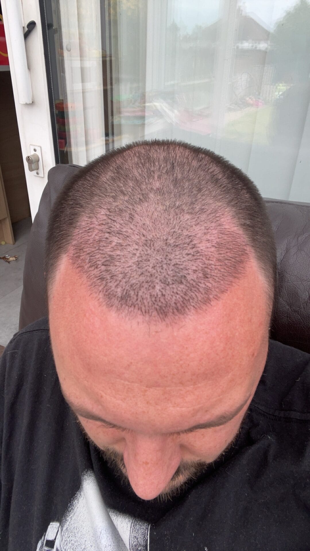 no scabs after hair transplant