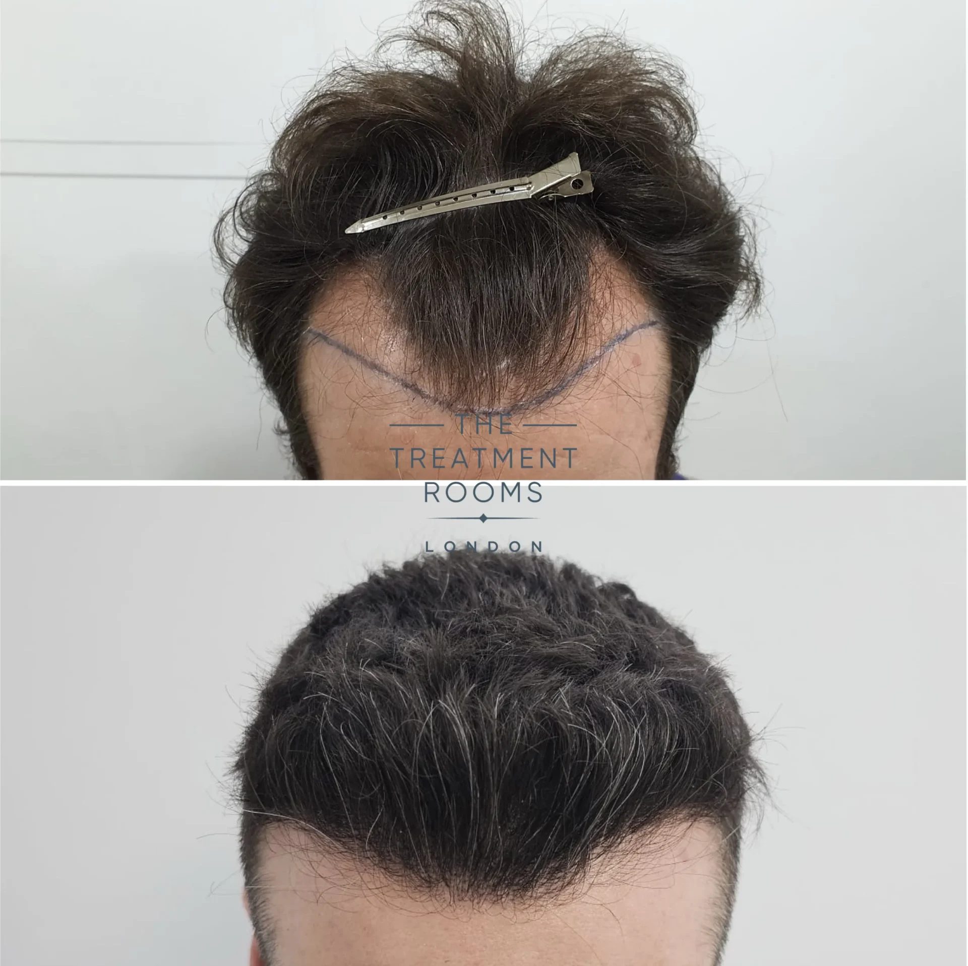 norwood 3 hair loss and hair transplant surgery