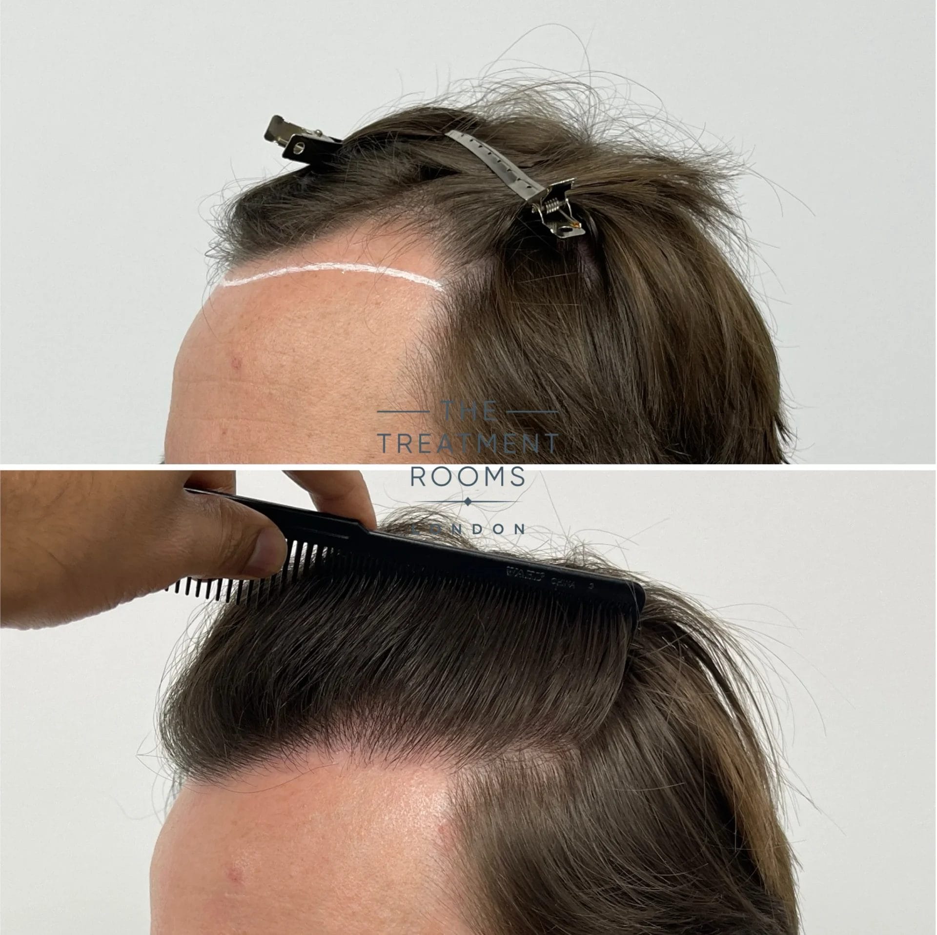 norwood 3 hair transplant cost