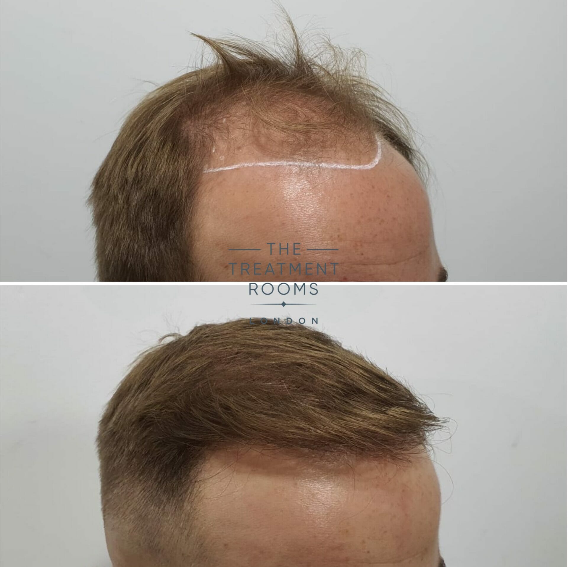 norwood 4 hair loss