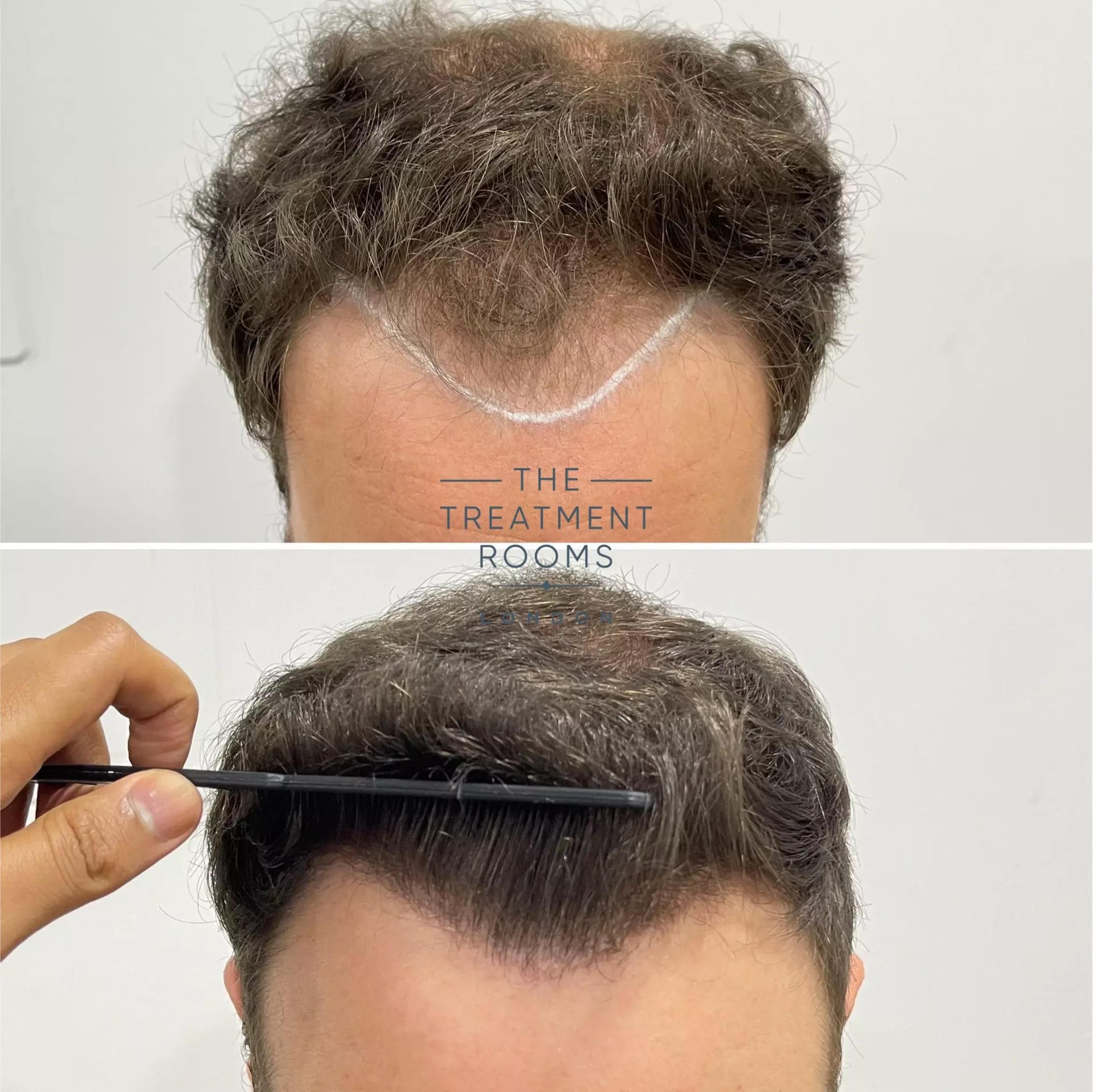 norwood 4 hair transplant cost