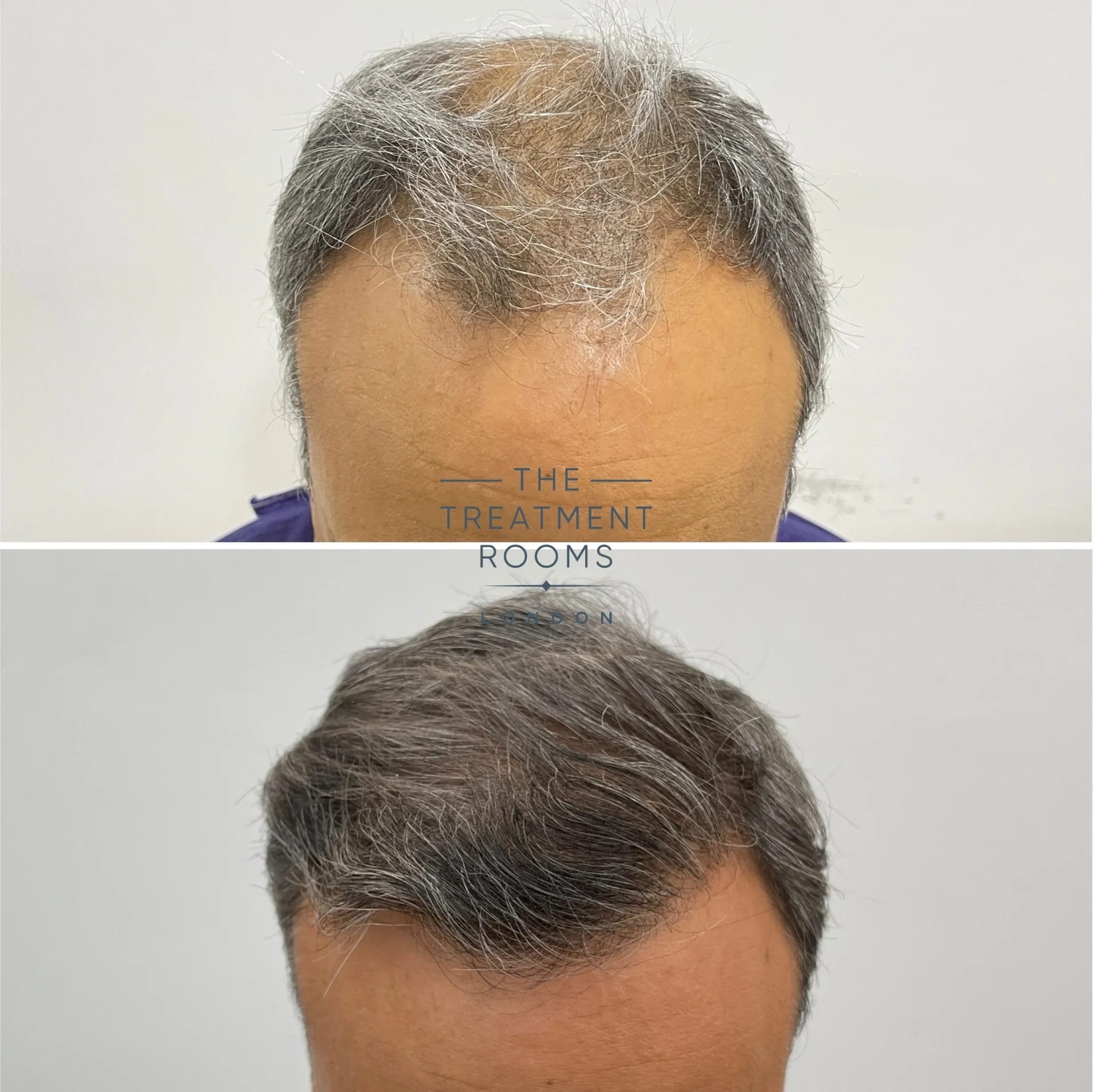 norwood 5 hair loss