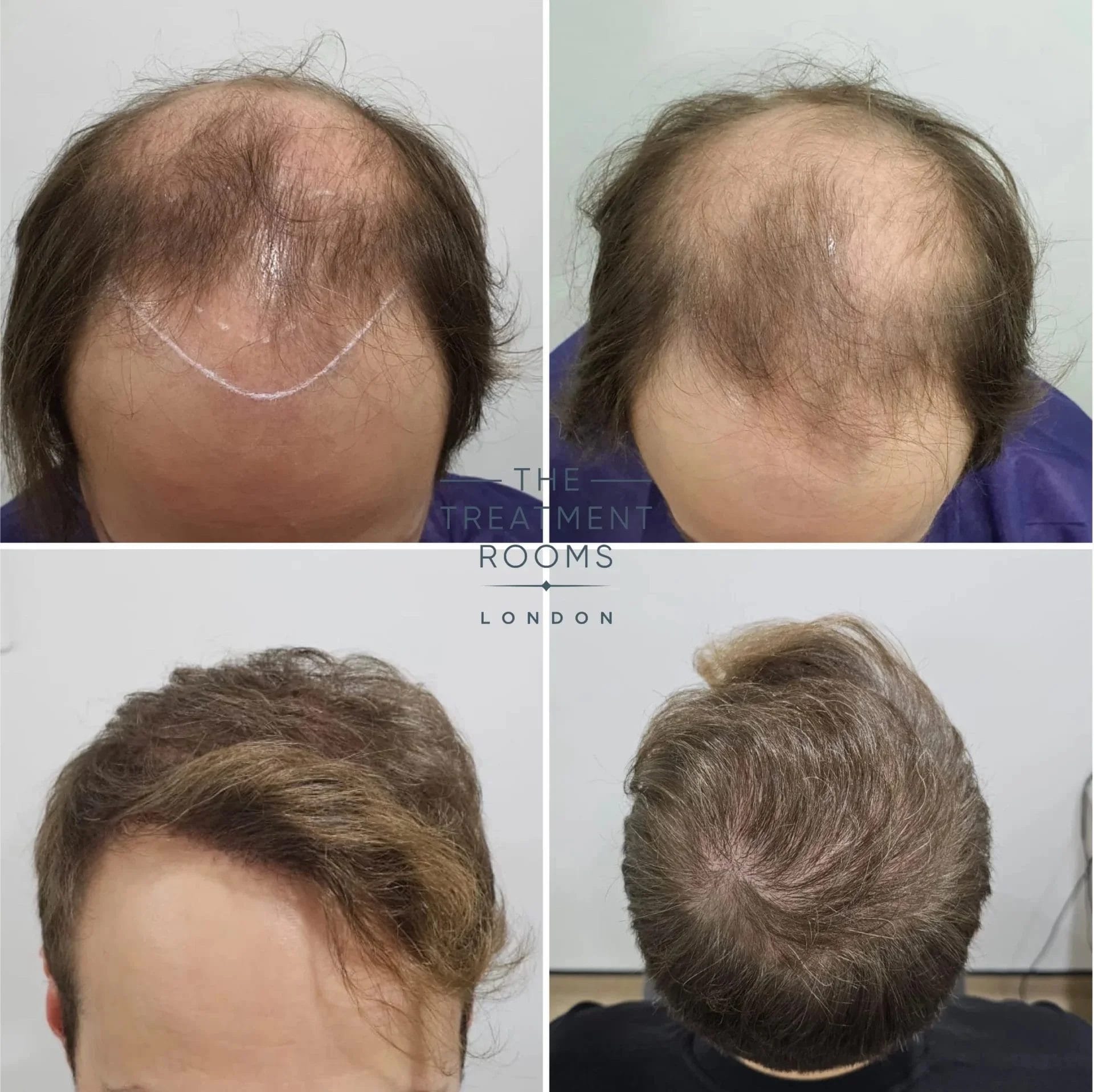 norwood 6 hair loss