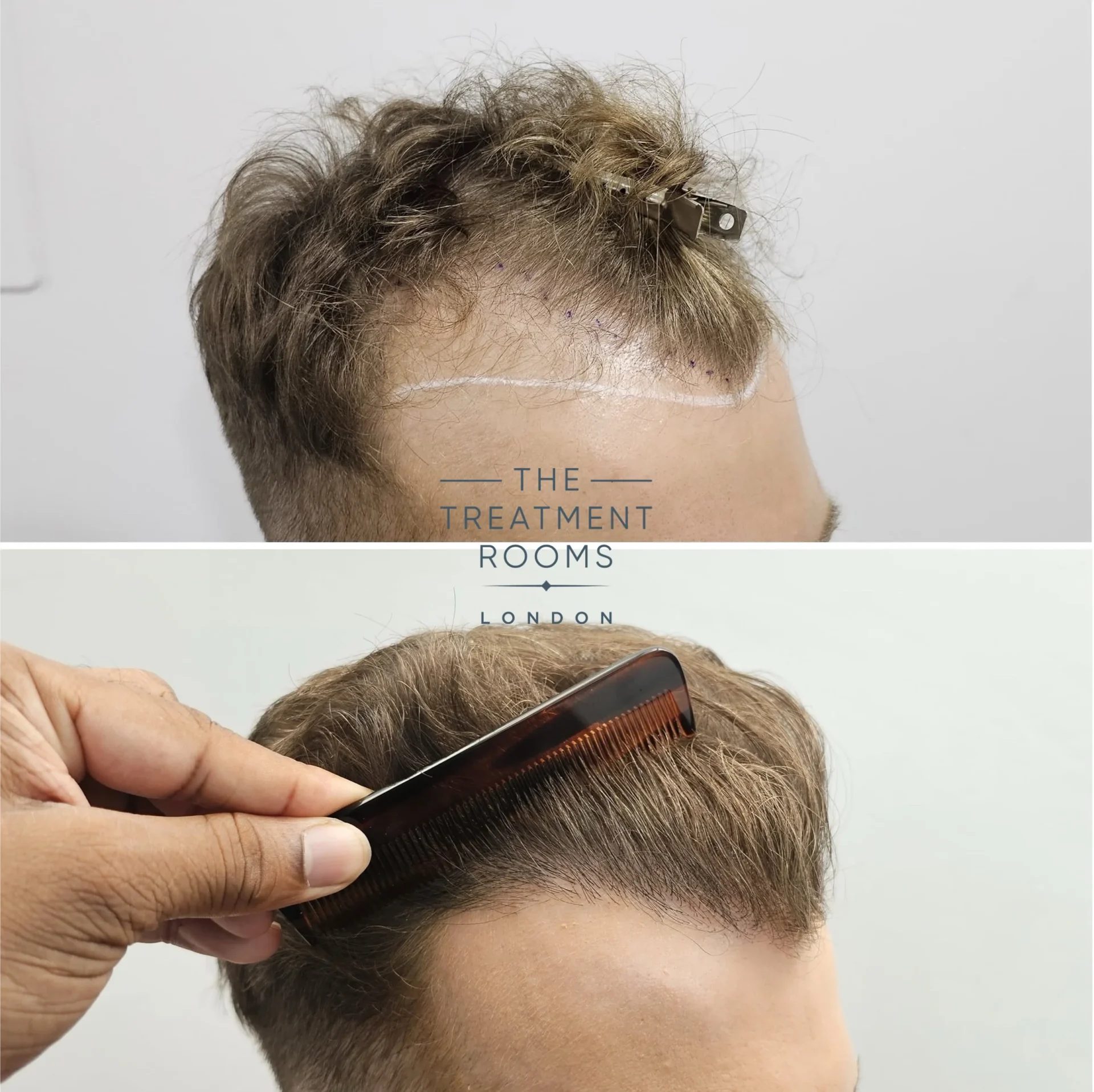 receding hairline 1499 grafts before and after fue hair transplant