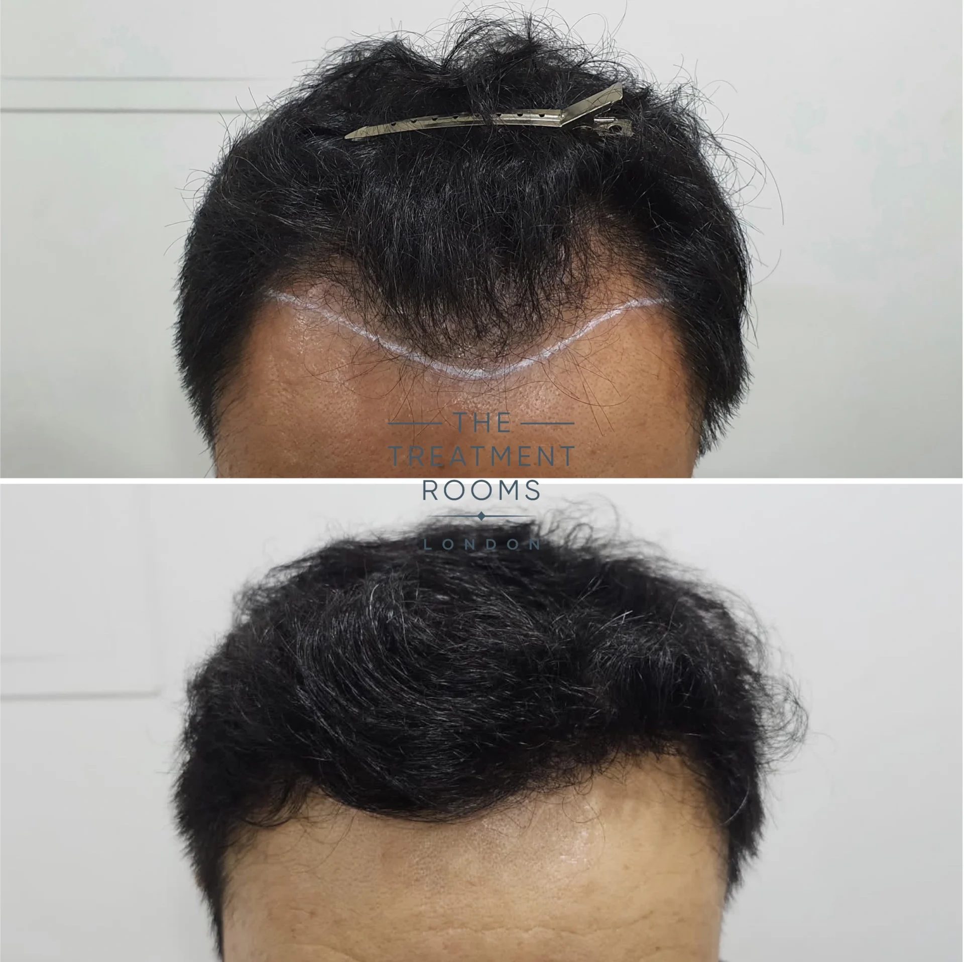 receding hairline fue hair transplant 1178 grafts result receding hairline fue hair transplant 1178 grafts result