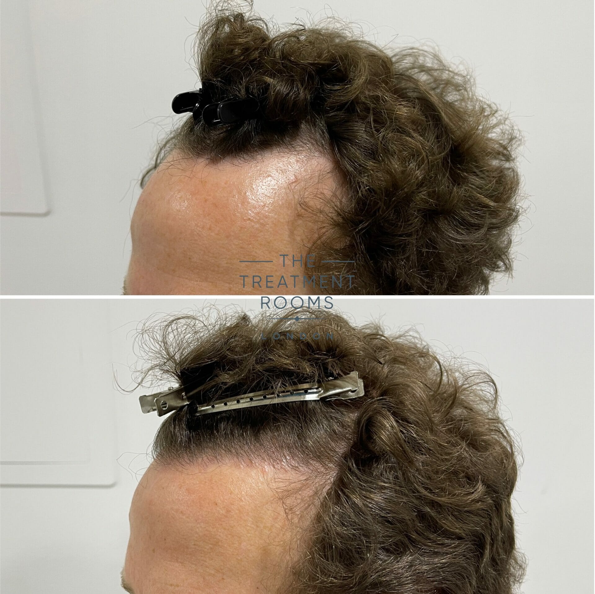 receding hairline fue hair transplant 1304 grafts