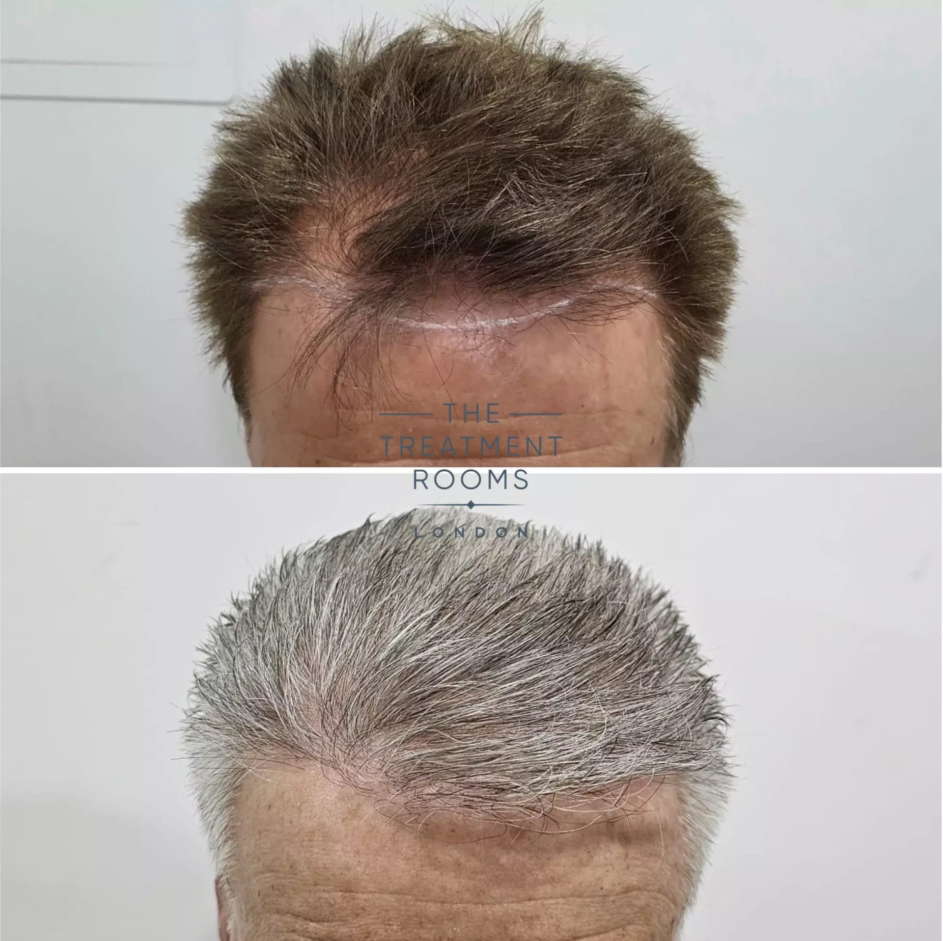 receding hairline fue transplant 2126 grafts