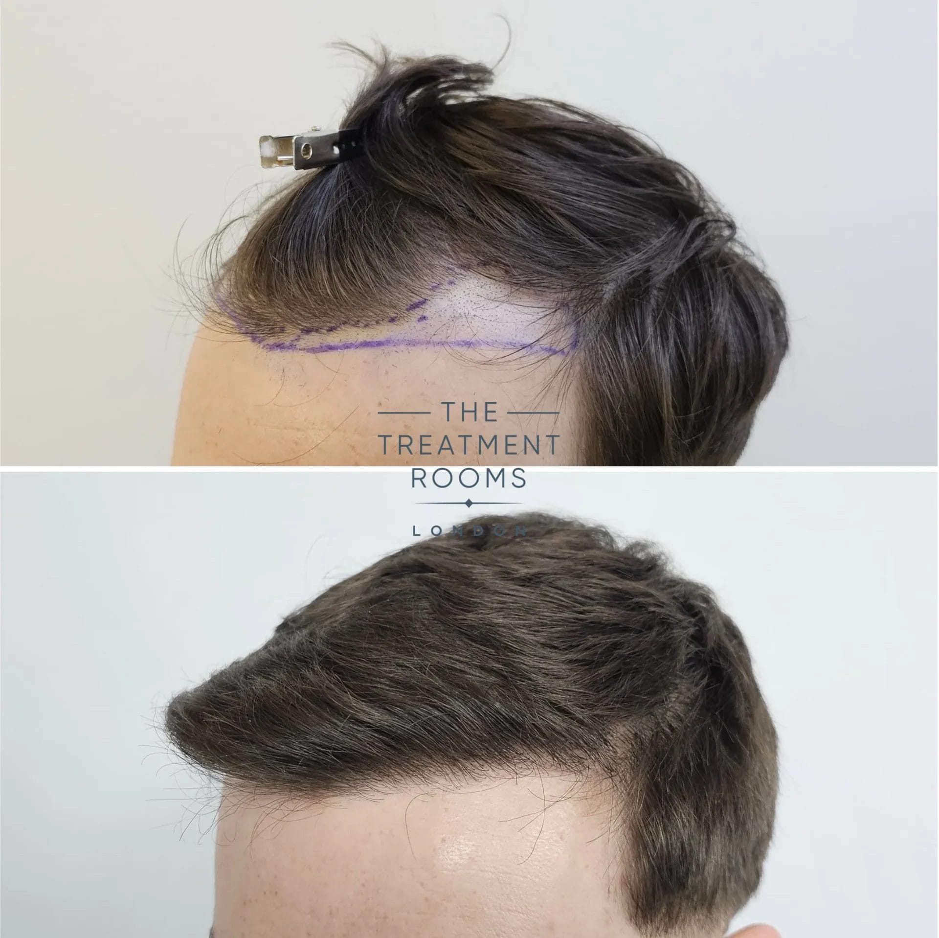 receding hairline fue transplant before and after 869 grafts