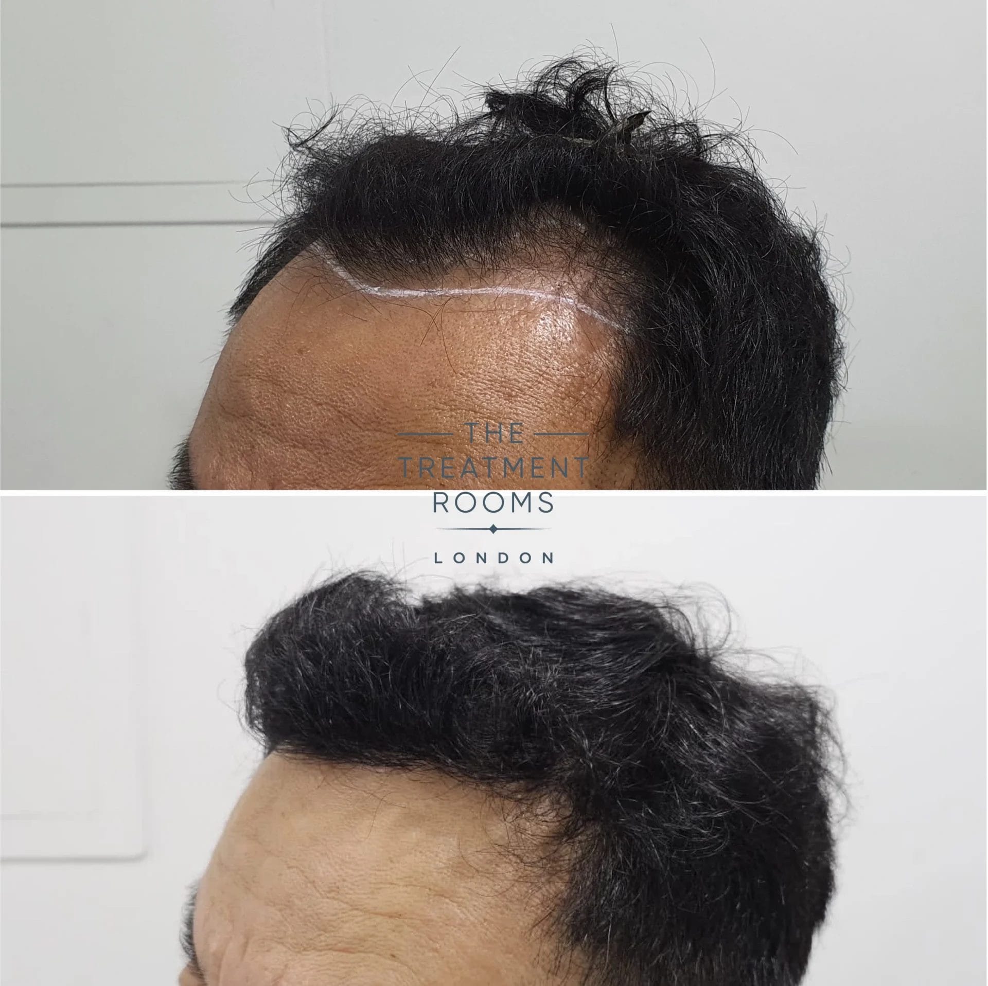 receding hairline hair transplant 1178 grafts before and after