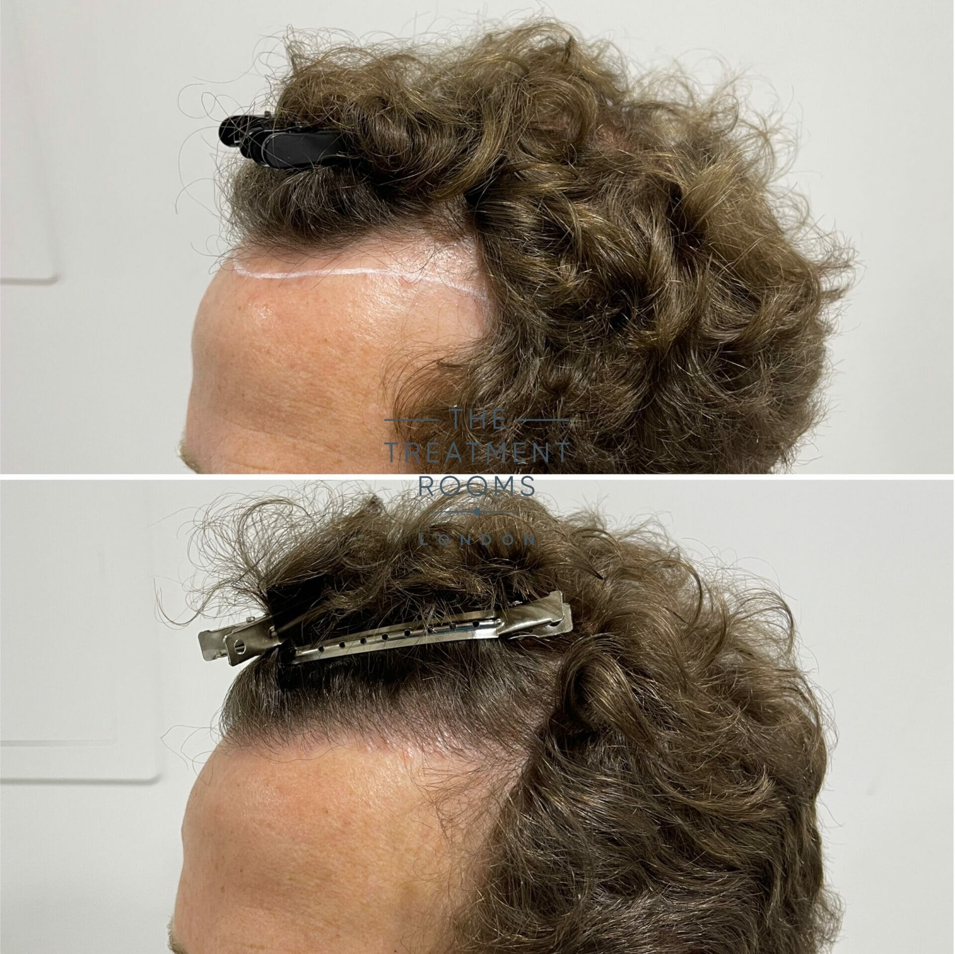 receding hairline hair transplant 1304 grafts