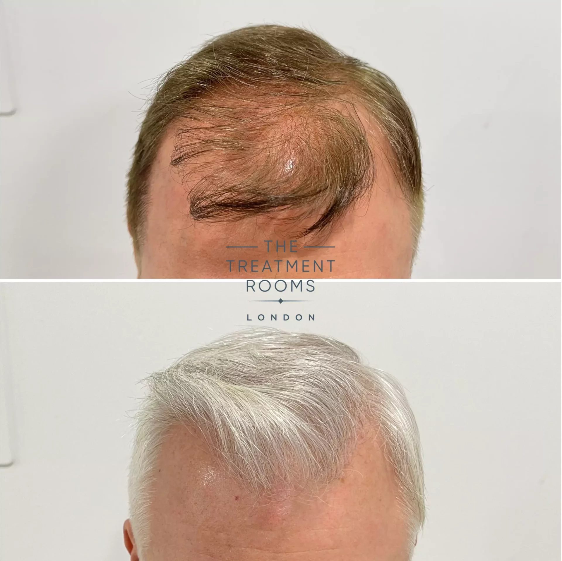 receding hairline hair transplant 1495 grafts before and after receding hairline hair transplant 1495 grafts before and after