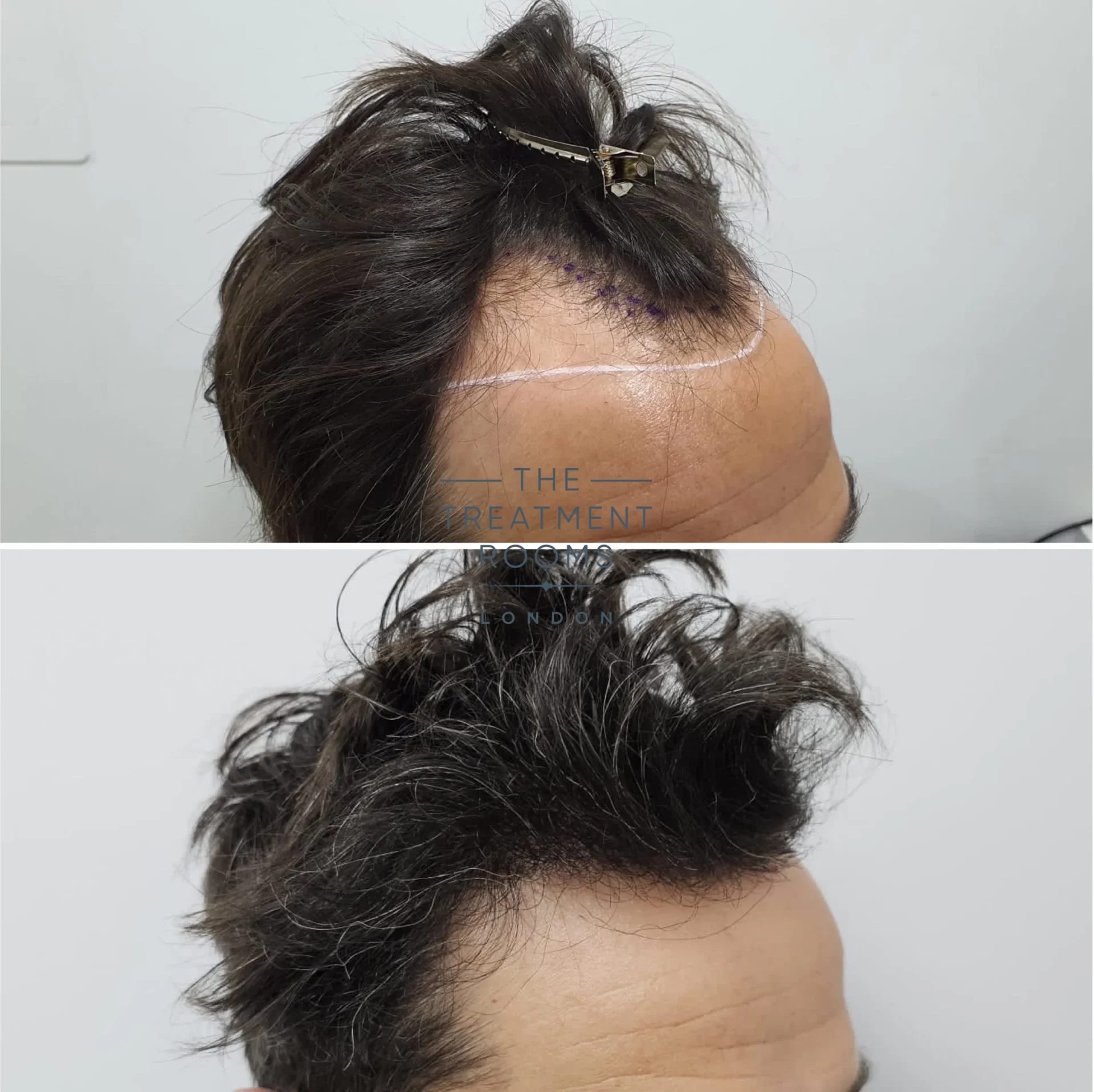 receding hairline hair transplant 1739 grafts receding hairline hair transplant 1739 grafts