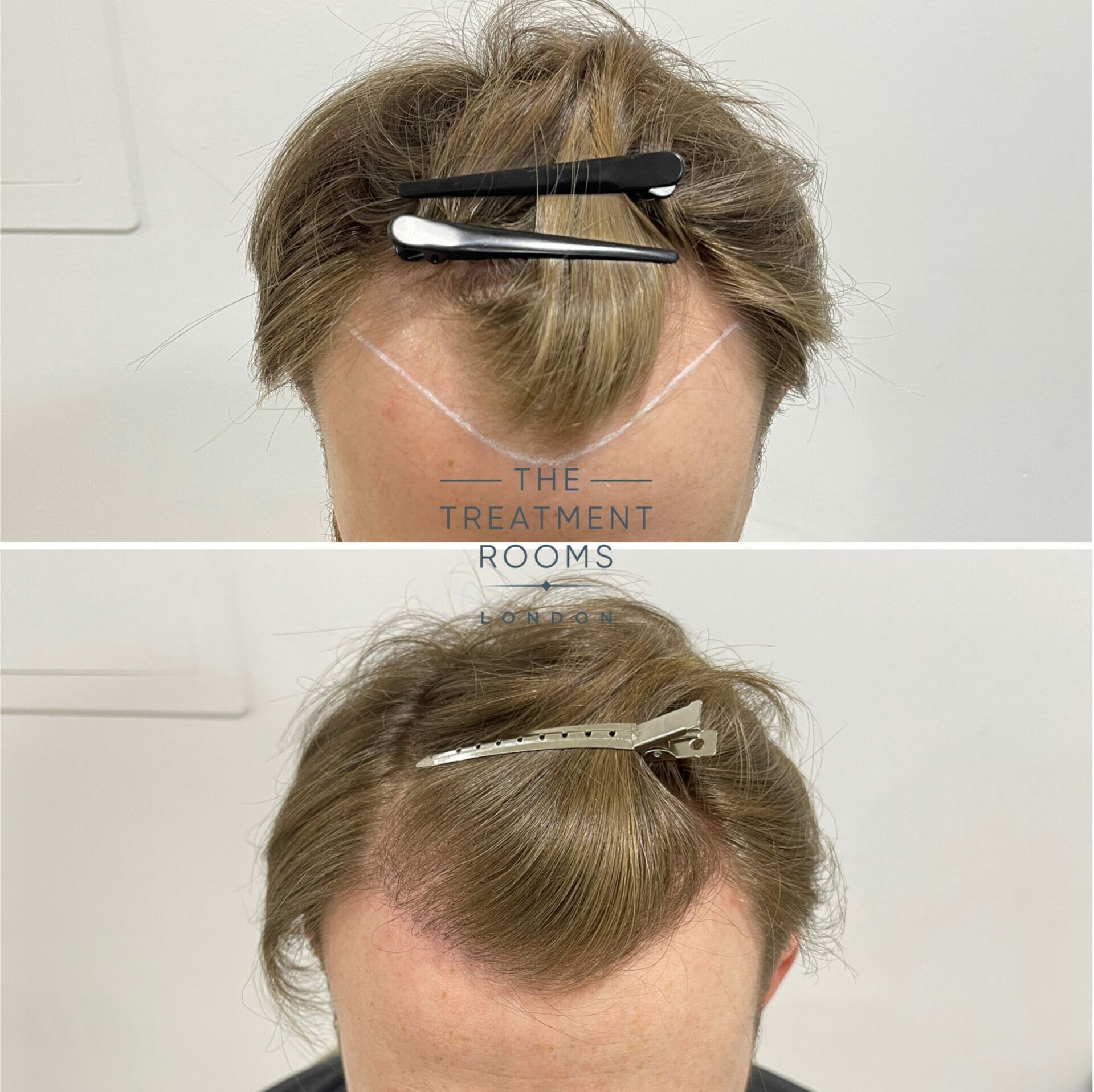 Hair receding online