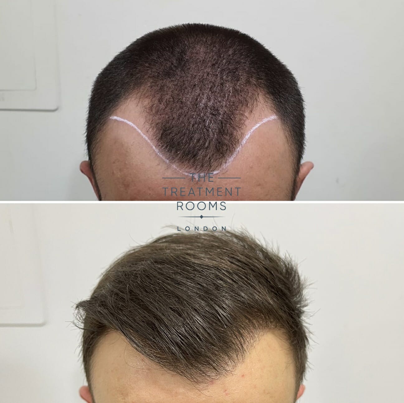 receding hairline transplant receding hairline transplant