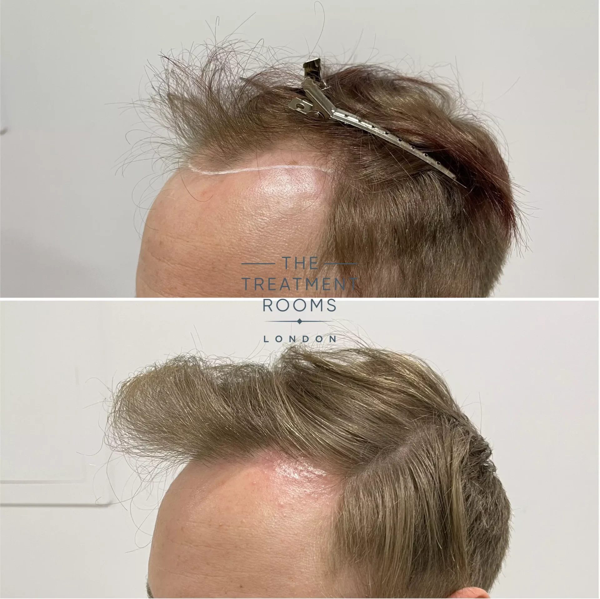 receding hairline transplant 1693 grafts before and after receding hairline transplant 1693 grafts before and after