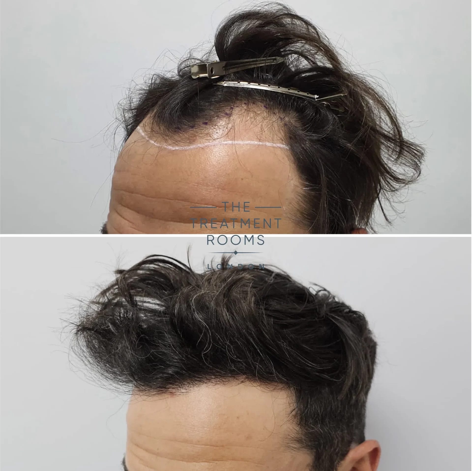 receding hairline transplant 1739 grafts