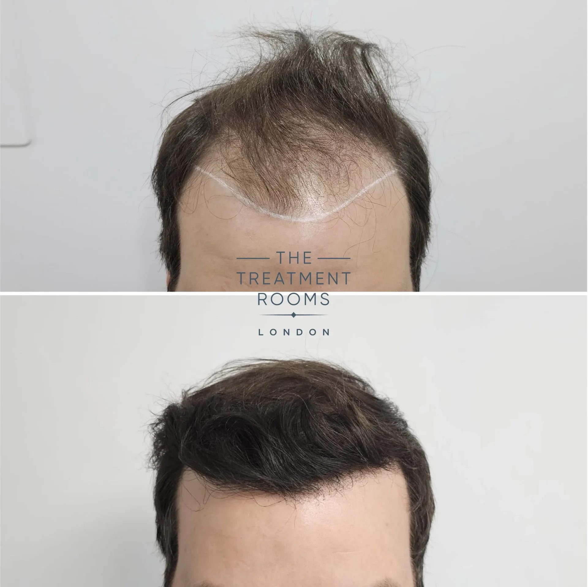 receding hairline transplant 2198 grafts before and after