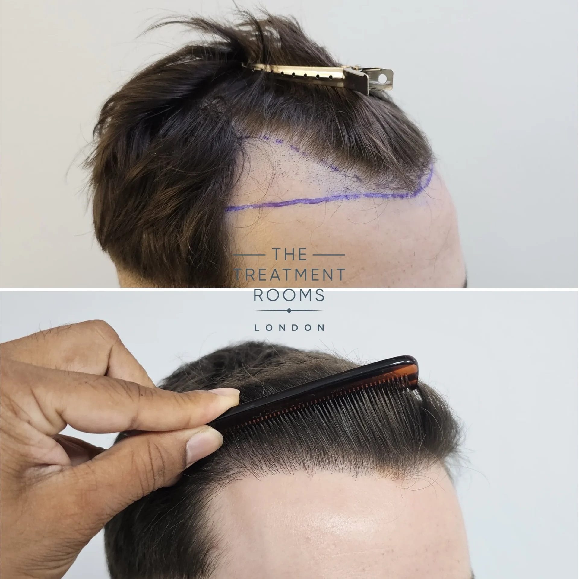 receding hairline transplant before and after 869 grafts