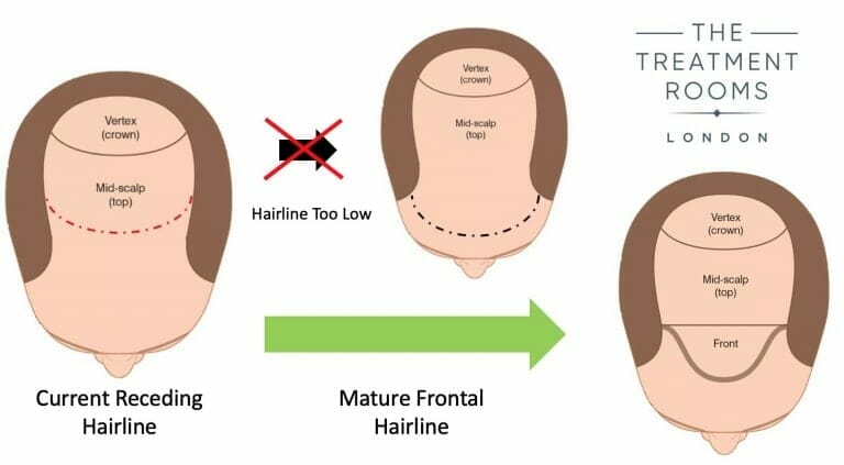 receding hairline transplant cost