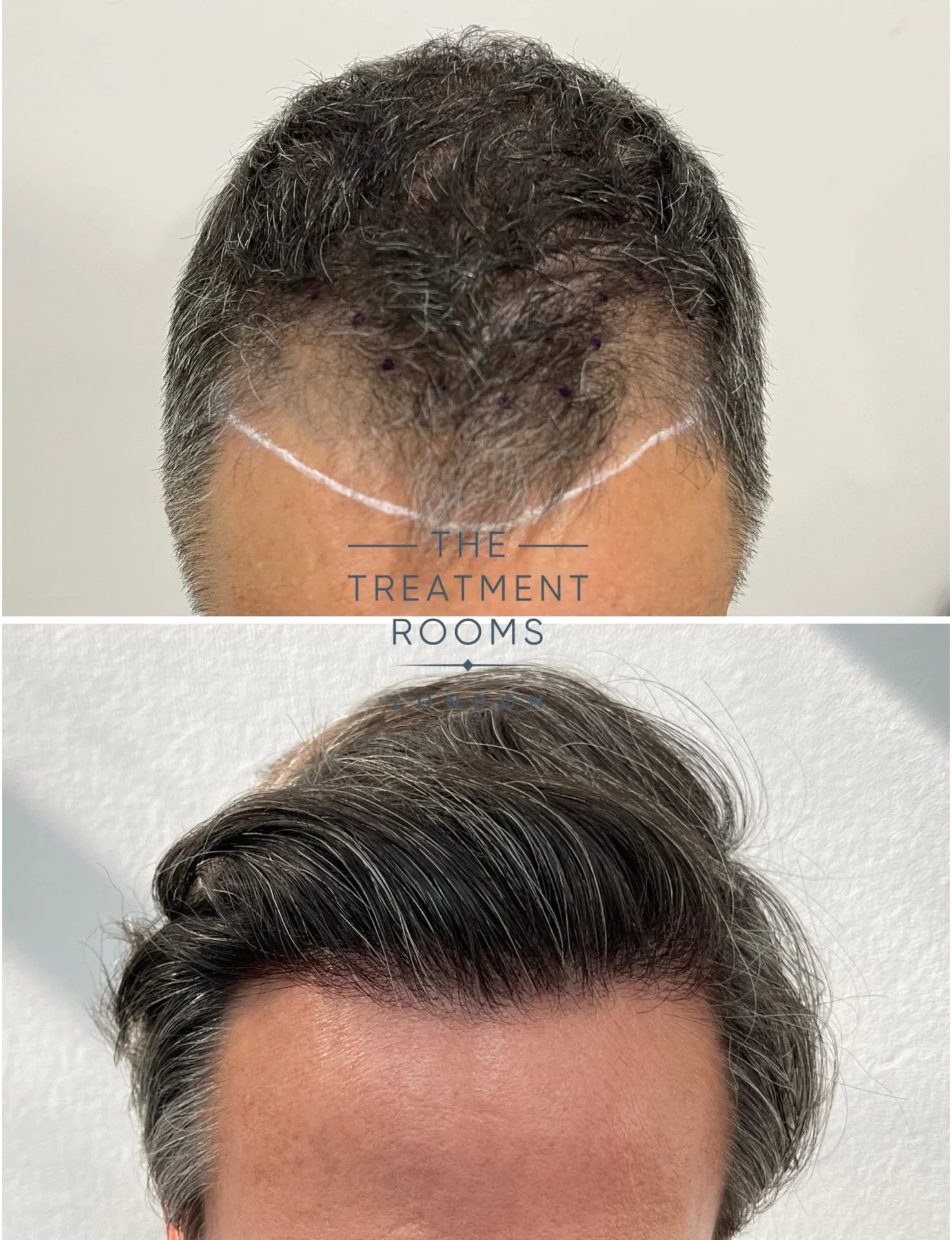 receding hairline transplant london before and after 2239 grafts