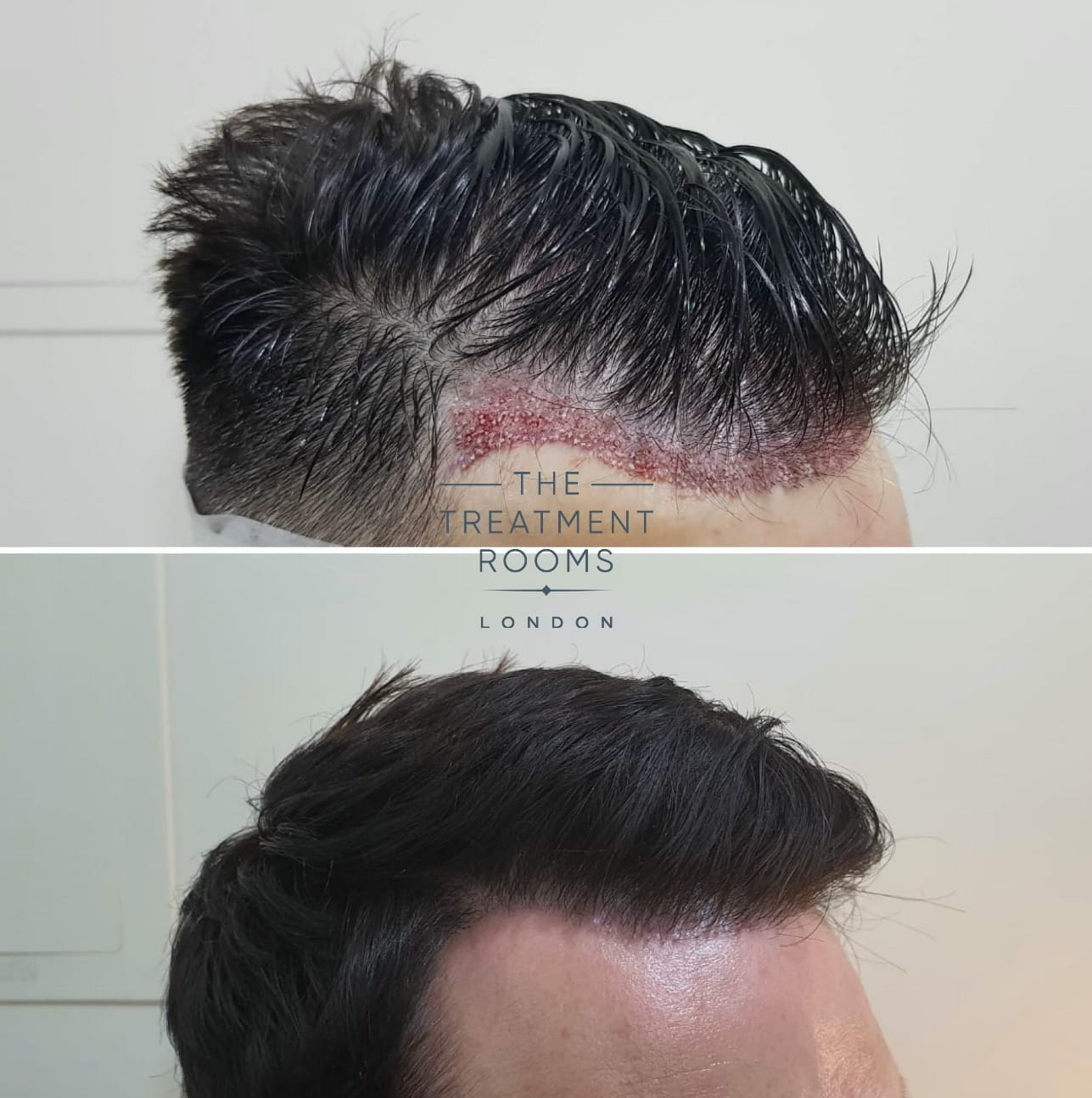 An In Depth Guide To Receding Hairline Treatment